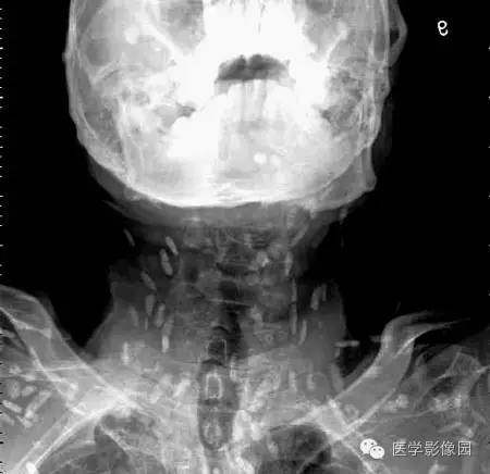 “囊虫病”图文精讲