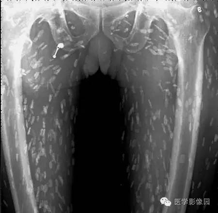“囊虫病”图文精讲 “囊虫病”图文精讲