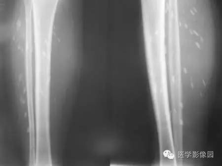 “囊虫病”图文精讲 “囊虫病”图文精讲