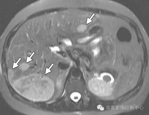 易出血可癌变的肝细胞腺瘤——炎性肝细胞腺瘤