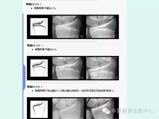 【PPT】儿童骨龄、成年身高测评