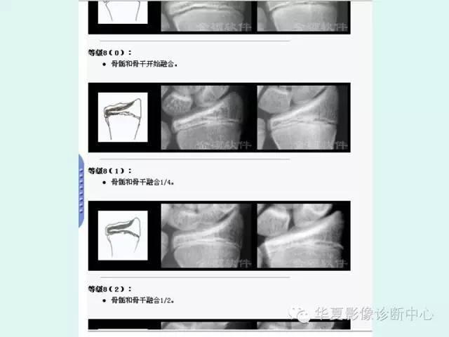 【PPT】儿童骨龄、成年身高测评