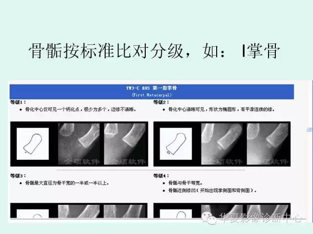 【PPT】儿童骨龄、成年身高测评