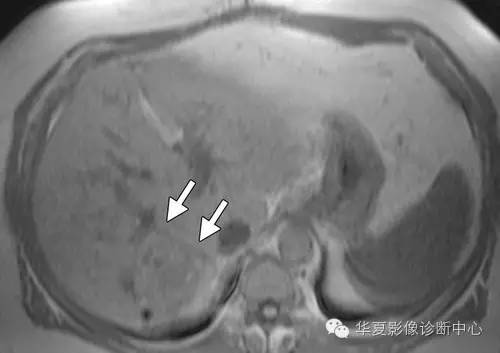 脂肪变性的肝细胞腺瘤——HNF-1α基因突变型肝细胞腺瘤 脂肪变性的肝细胞腺瘤——HNF-1α基因突变型肝细胞腺瘤