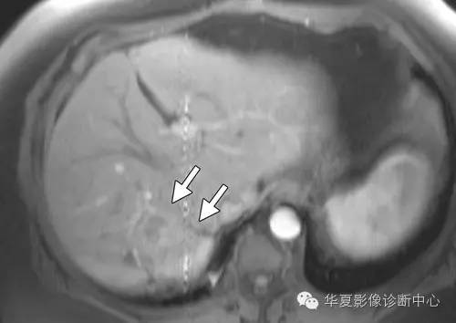 脂肪变性的肝细胞腺瘤——HNF-1α基因突变型肝细胞腺瘤 脂肪变性的肝细胞腺瘤——HNF-1α基因突变型肝细胞腺瘤