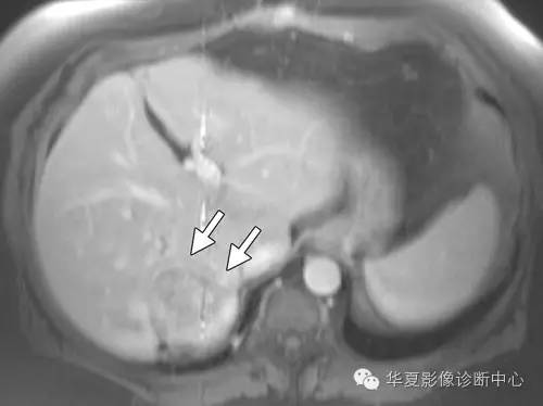 脂肪变性的肝细胞腺瘤——HNF-1α基因突变型肝细胞腺瘤 脂肪变性的肝细胞腺瘤——HNF-1α基因突变型肝细胞腺瘤