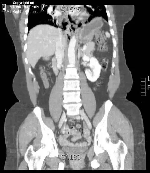 【病例】自发性食管穿孔1例X线及CT影像表现 【病例】自发性食管穿孔1例X线及CT影像表现