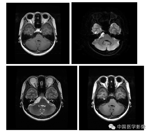 表皮样囊肿、皮样囊肿与畸胎瘤 表皮样囊肿、皮样囊肿与畸胎瘤