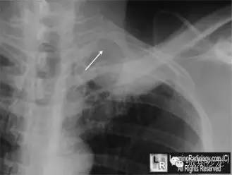 【病例】肺上沟瘤1例X线影像表现 【病例】肺上沟瘤1例X线影像表现