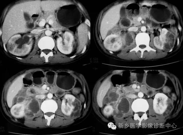 4个腰大肌病变的影像诊断与鉴别