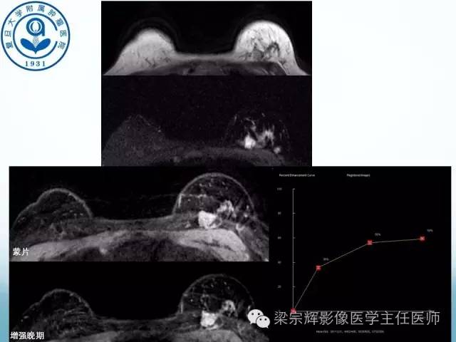 【病例】乳腺纤维腺瘤1例X线及MR影像表现