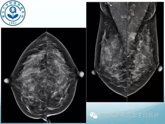 【病例】乳腺纤维腺瘤1例X线及MR影像表现
