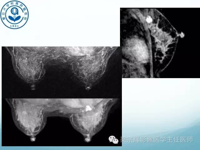 【病例】乳腺纤维腺瘤1例X线及MR影像表现