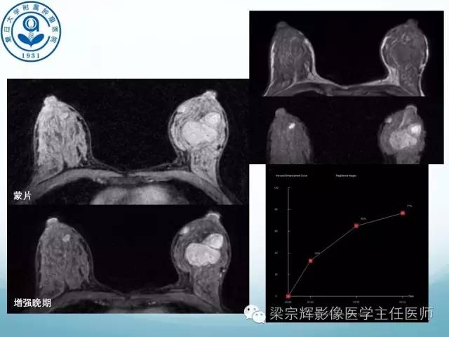【病例】乳腺纤维腺瘤1例X线及MR影像表现