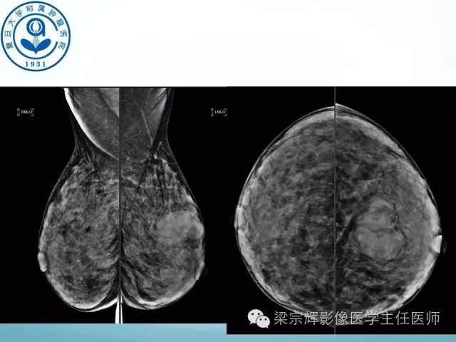【病例】乳腺纤维腺瘤1例X线及MR影像表现