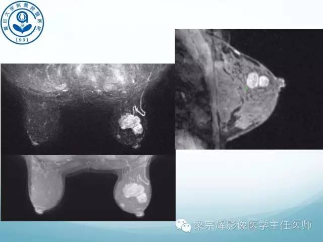 【病例】乳腺纤维腺瘤1例X线及MR影像表现