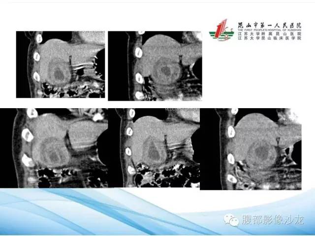 【病例】黄色肉芽肿性胆囊炎1例CT影像表现 【病例】黄色肉芽肿性胆囊炎1例CT影像表现