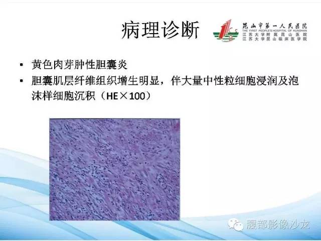【病例】黄色肉芽肿性胆囊炎1例CT影像表现 【病例】黄色肉芽肿性胆囊炎1例CT影像表现