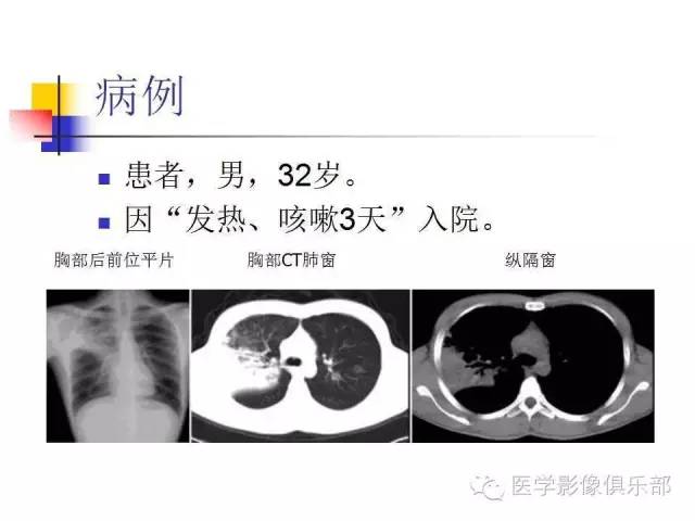 【病例】大叶性肺炎1例X线及CT影像表现