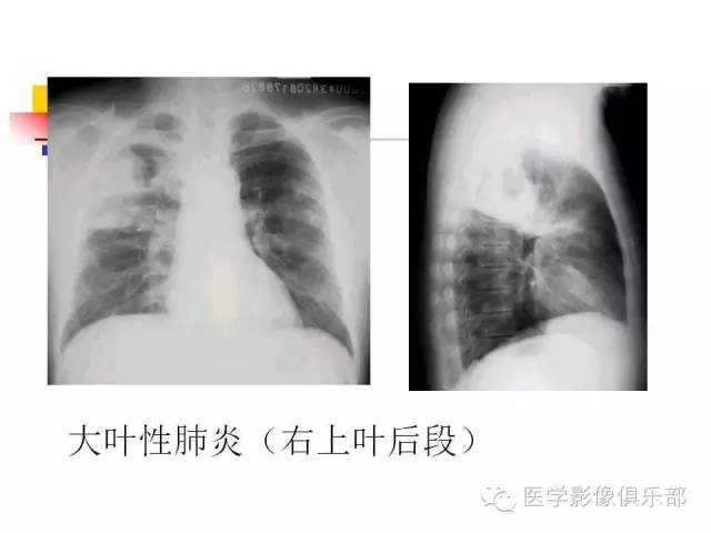 【病例】大叶性肺炎1例X线及CT影像表现