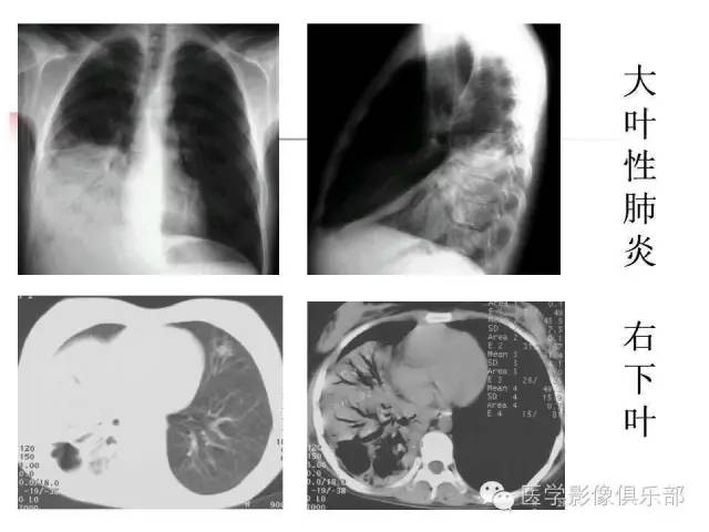 【病例】大叶性肺炎1例X线及CT影像表现