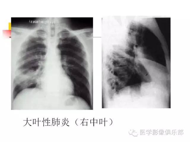 【病例】大叶性肺炎1例X线及CT影像表现