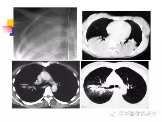【病例】大叶性肺炎1例X线及CT影像表现