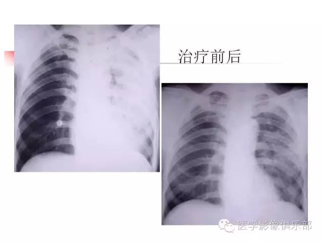 【病例】大叶性肺炎1例X线及CT影像表现