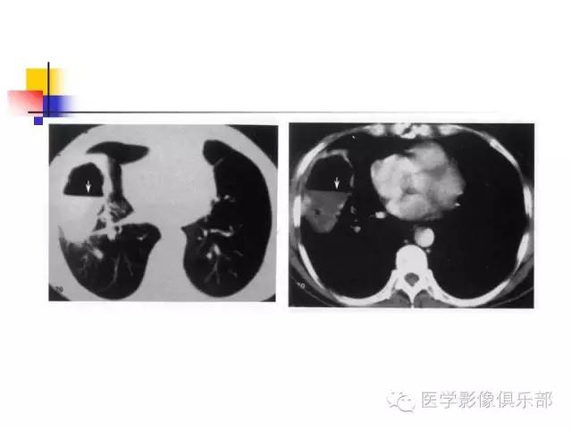 【病例】大叶性肺炎1例X线及CT影像表现