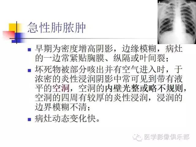 【病例】大叶性肺炎1例X线及CT影像表现