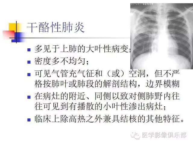 【病例】大叶性肺炎1例X线及CT影像表现