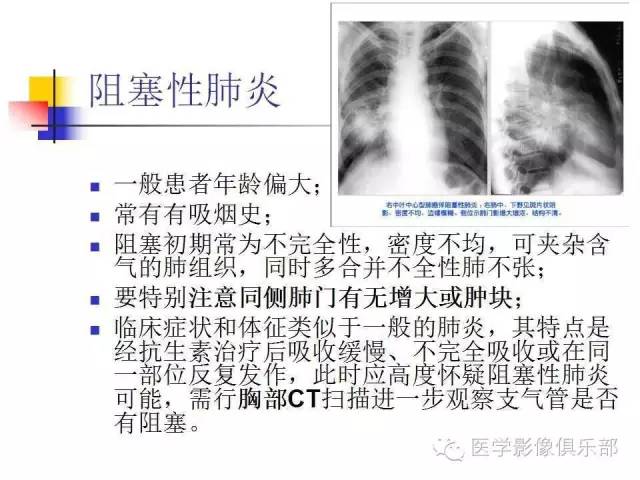 【病例】大叶性肺炎1例X线及CT影像表现