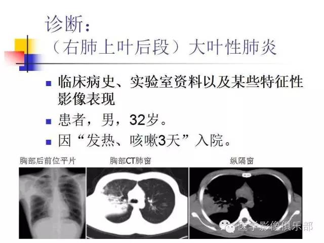 【病例】大叶性肺炎1例X线及CT影像表现