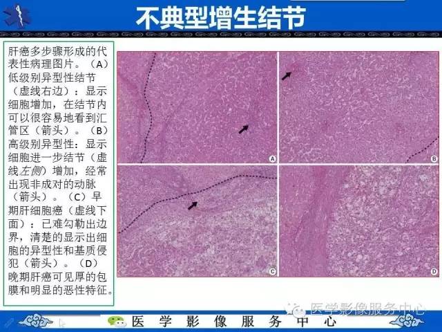 【PPT】肝癌生成过程中病理改变与MRI关系