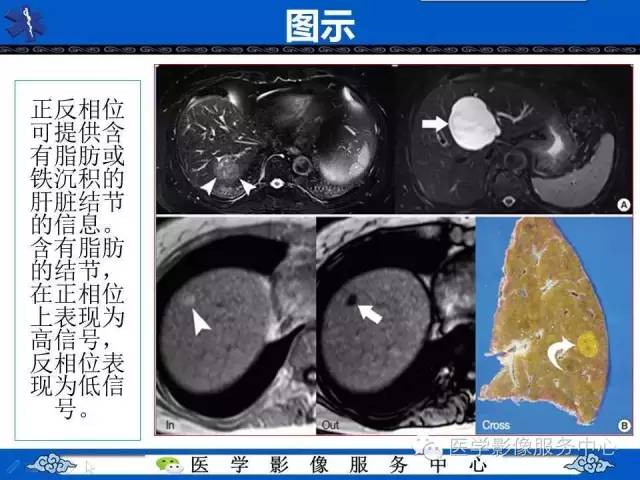 【PPT】肝癌生成过程中病理改变与MRI关系