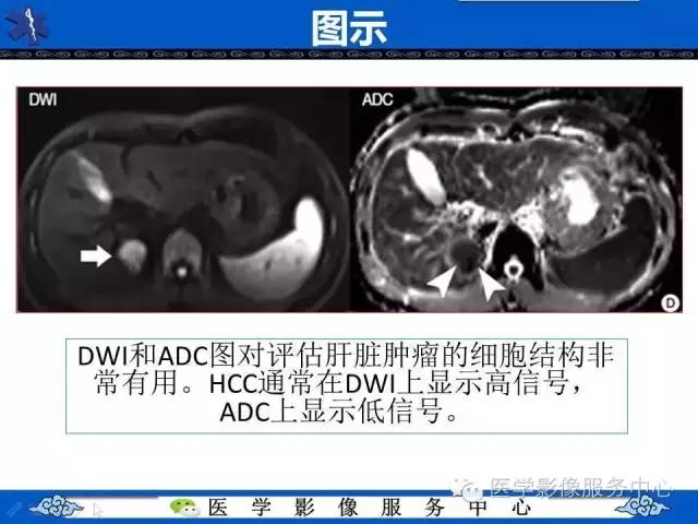 【PPT】肝癌生成过程中病理改变与MRI关系