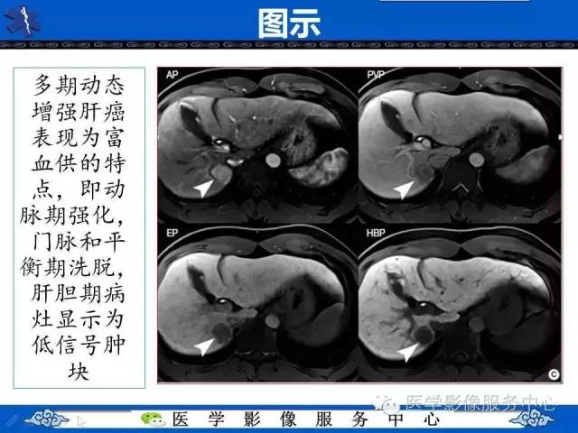 【PPT】肝癌生成过程中病理改变与MRI关系