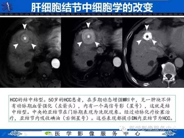 【PPT】肝癌生成过程中病理改变与MRI关系