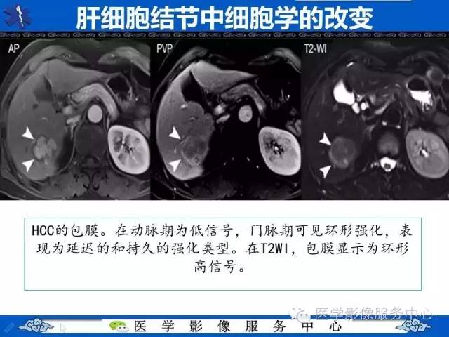 【PPT】肝癌生成过程中病理改变与MRI关系