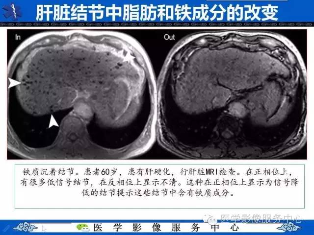 【PPT】肝癌生成过程中病理改变与MRI关系