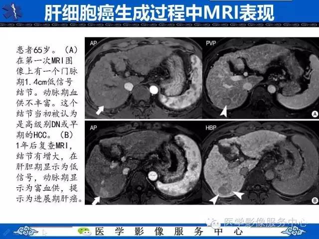 【PPT】肝癌生成过程中病理改变与MRI关系
