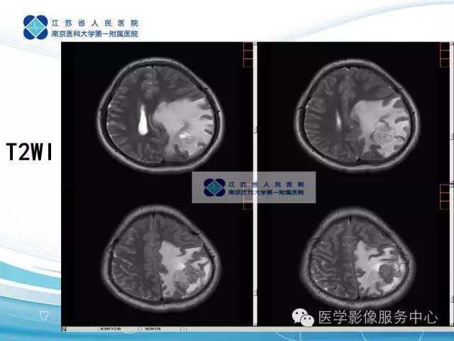 【病例】左额叶胶质肉瘤1例MR影像表现
