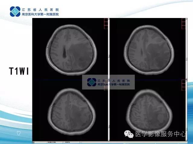 【病例】左额叶胶质肉瘤1例MR影像表现