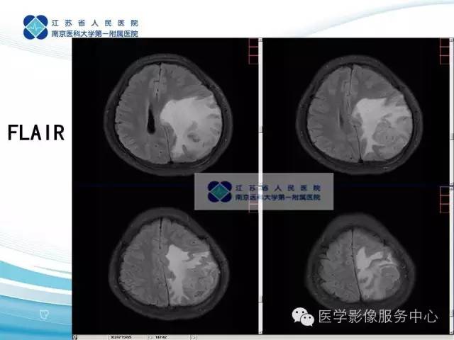 【病例】左额叶胶质肉瘤1例MR影像表现