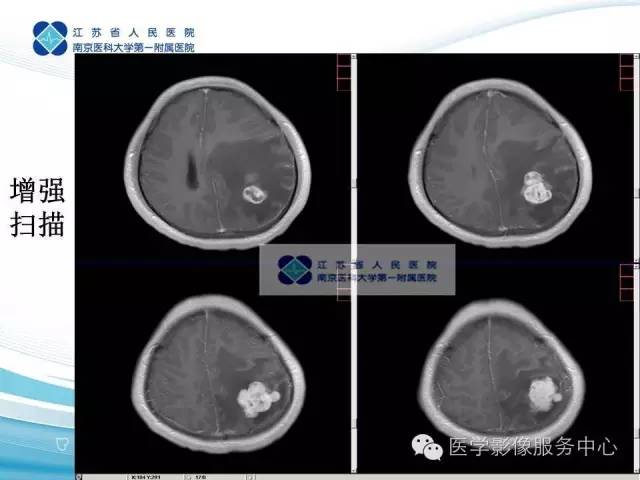 【病例】左额叶胶质肉瘤1例MR影像表现