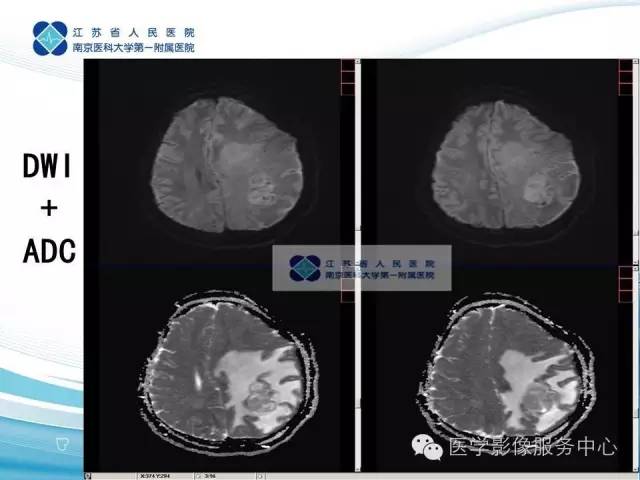【病例】左额叶胶质肉瘤1例MR影像表现