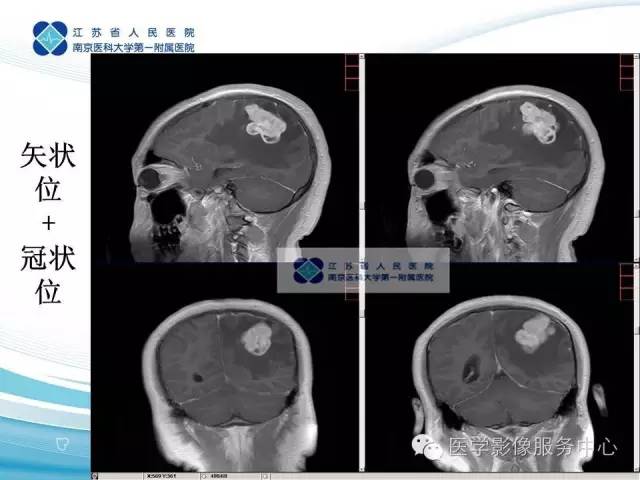 【病例】左额叶胶质肉瘤1例MR影像表现