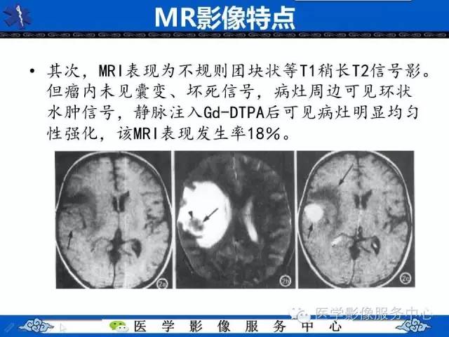 【病例】左额叶胶质肉瘤1例MR影像表现
