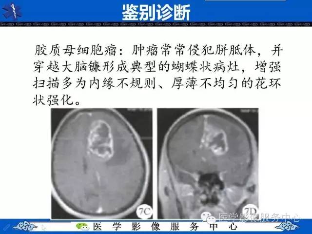 【病例】左额叶胶质肉瘤1例MR影像表现