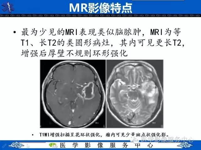 【病例】左额叶胶质肉瘤1例MR影像表现